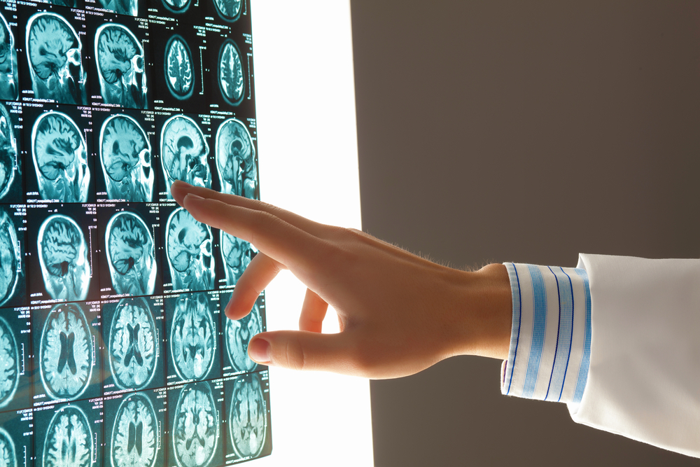 The Risk Of A TBI In A Slip-and-Fall Accident